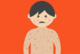 VACCINATION : La rougeole